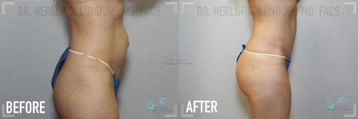 Before & After Tummy Tuck Case 146 Right Side View in St. Louis, MO