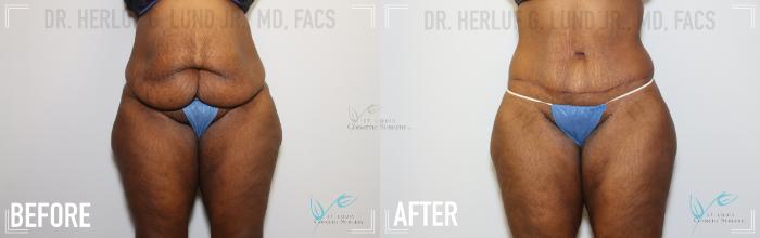 Before & After Liposuction Case 147 Front View in St. Louis, MO