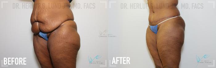 Before & After Liposuction Case 147 Left Oblique View in St. Louis, MO