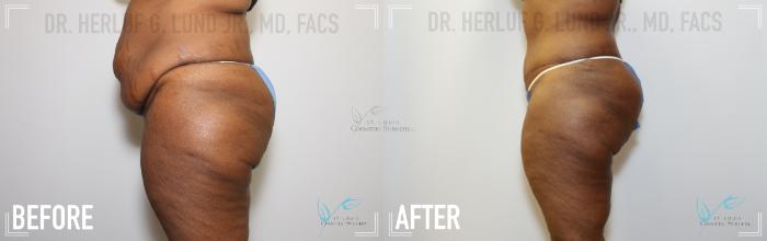 Before & After Tummy Tuck Case 147 Left Side View in St. Louis, MO