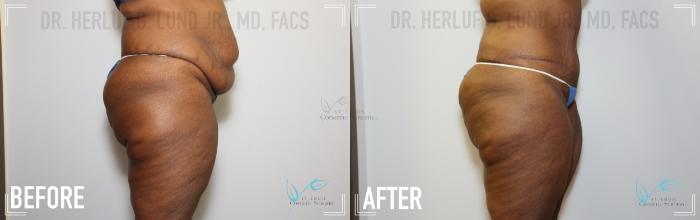Before & After Liposuction Case 147 Right Side View in St. Louis, MO
