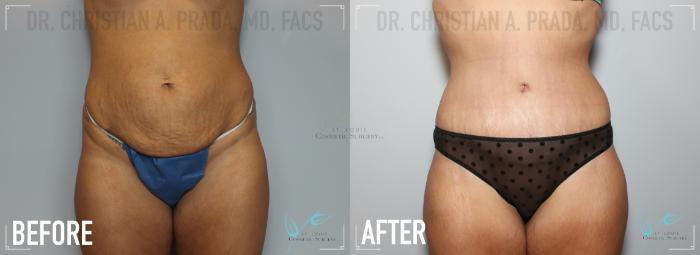 Before & After Tummy Tuck Case 152 Front View in St. Louis, MO