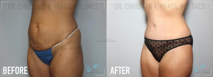 Before & After Tummy Tuck Case 152 Left Oblique View in St. Louis, MO