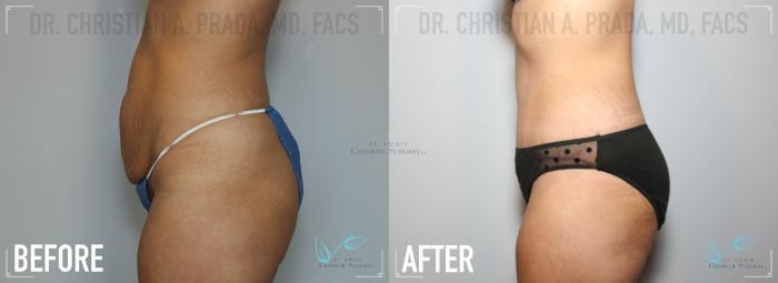 Before & After Tummy Tuck Case 152 Left Side View in St. Louis, MO