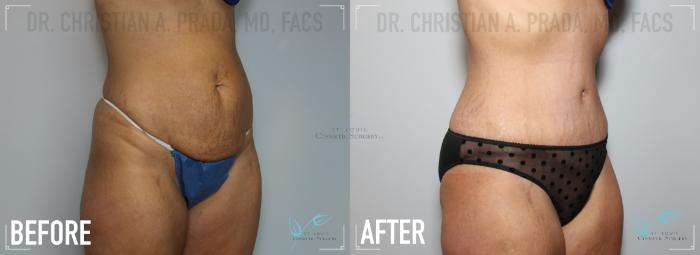 Before & After Tummy Tuck Case 152 Right Oblique View in St. Louis, MO