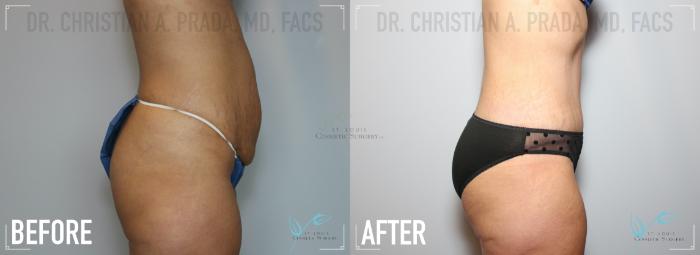 Before & After Tummy Tuck Case 152 Right Side View in St. Louis, MO