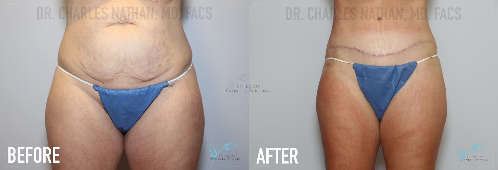 Before & After Tummy Tuck Case 157 Front View in St. Louis, MO