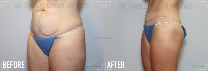 Before & After Tummy Tuck Case 157 Left Oblique View in St. Louis, MO