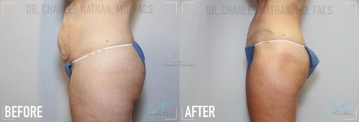 Before & After Tummy Tuck Case 157 Left Side View in St. Louis, MO