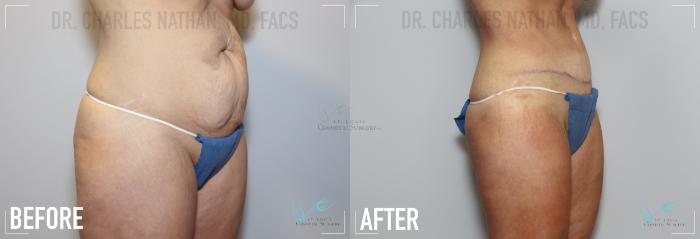 Before & After Tummy Tuck Case 157 Right Oblique View in St. Louis, MO