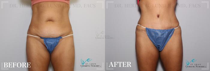 Before & After Tummy Tuck Case 169 Front View in St. Louis, MO