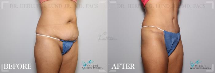 Before & After Tummy Tuck Case 169 Right Oblique View in St. Louis, MO