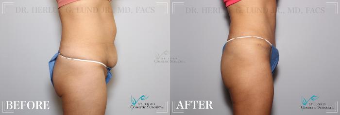 Before & After Tummy Tuck Case 169 Right Side View in St. Louis, MO