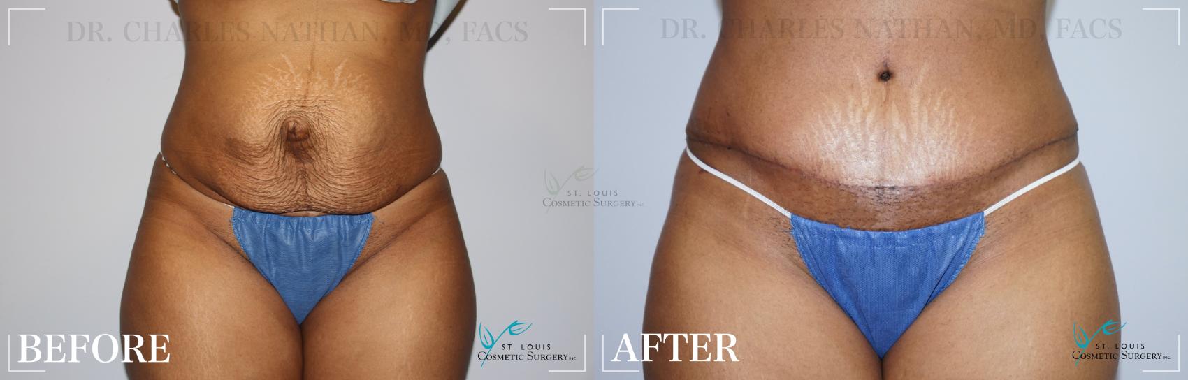 Before & After Tummy Tuck Case 171 Front View in St. Louis, MO