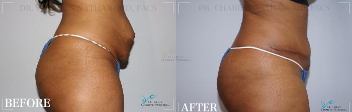 Before & After Tummy Tuck Case 171 Right Side View in St. Louis, MO