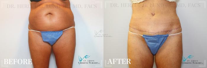 Before & After Tummy Tuck Case 173 Front View in St. Louis, MO