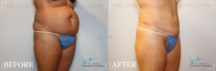 Before & After Tummy Tuck Case 173 Right Oblique View in St. Louis, MO