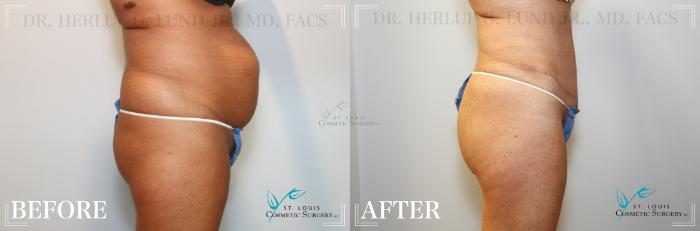Before & After Tummy Tuck Case 173 Right Side View in St. Louis, MO