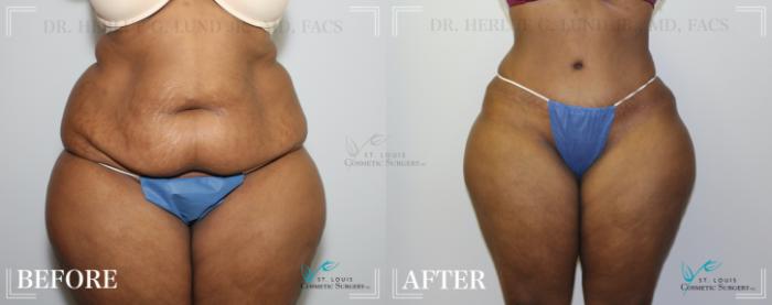 Before & After Tummy Tuck Case 191 Front View in St. Louis, MO