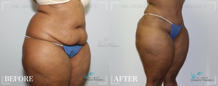 Before & After Tummy Tuck Case 191 Right Oblique View in St. Louis, MO
