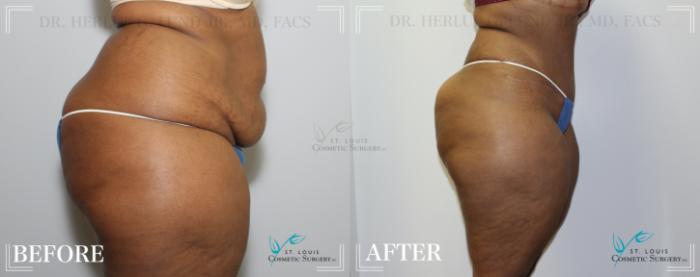 Before & After Tummy Tuck Case 191 Right Side View in St. Louis, MO