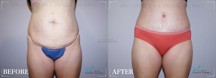Before & After Tummy Tuck Case 204 Front View in St. Louis, MO