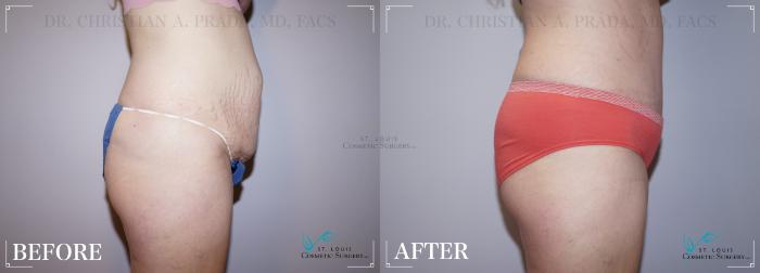 Before & After Tummy Tuck Case 204 Right Side View in St. Louis, MO
