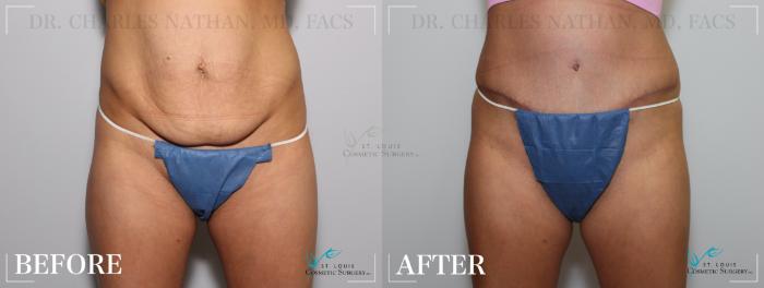 Before & After Tummy Tuck Case 207 Front View in St. Louis, MO