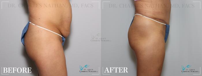Before & After Tummy Tuck Case 207 Right Side View in St. Louis, MO