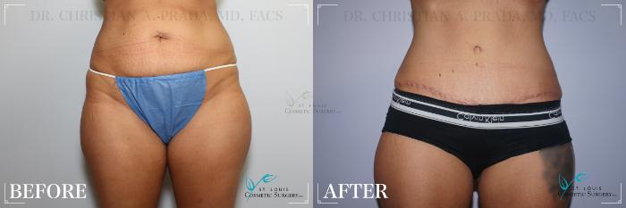 Before & After Tummy Tuck Case 211 Front View in St. Louis, MO