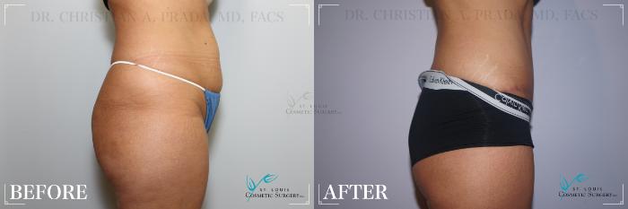 Before & After Tummy Tuck Case 211 Right Side View in St. Louis, MO