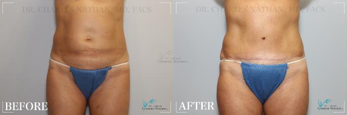 Before & After Tummy Tuck Case 216 Front View in St. Louis, MO