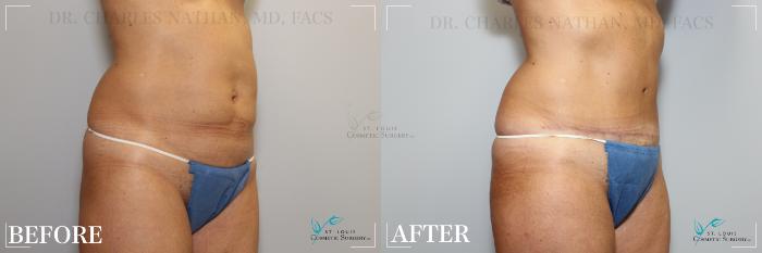 Before & After Tummy Tuck Case 216 Right Oblique View in St. Louis, MO