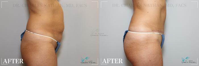 Before & After Tummy Tuck Case 216 Right Side View in St. Louis, MO