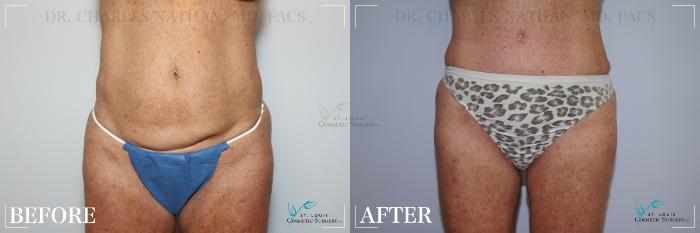 Before & After Tummy Tuck Case 217 Front View in St. Louis, MO