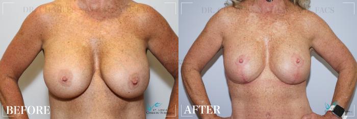Before & After Breast Lift Case 217 FRONT-BREASTS View in St. Louis, MO