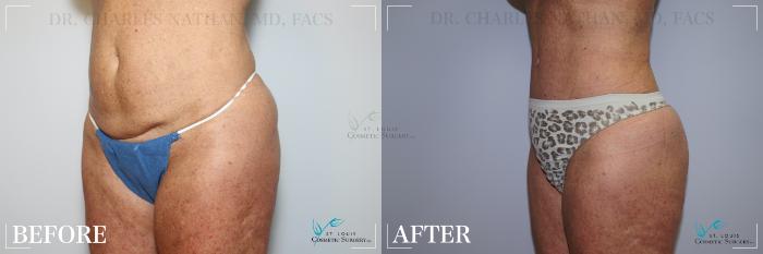Before & After Breast Lift Case 217 Left Oblique View in St. Louis, MO