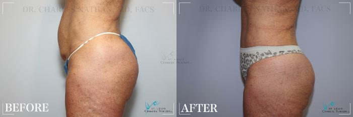 Before & After Tummy Tuck Case 217 Left Side View in St. Louis, MO