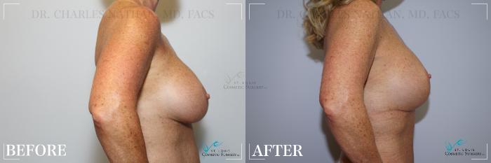 Before & After Breast Lift Case 217 SIDE-BREASTS View in St. Louis, MO