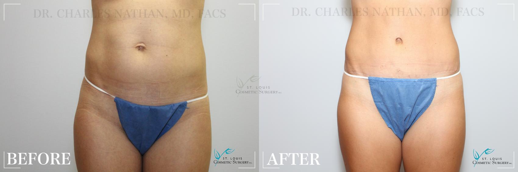 Before & After Tummy Tuck Case 218 Front View in St. Louis, MO