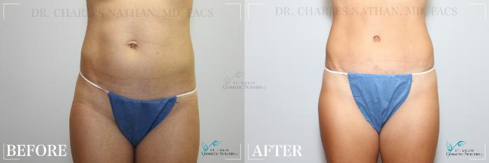 Before & After Tummy Tuck Case 218 Front View in St. Louis, MO