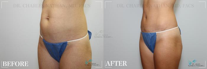 Before & After Tummy Tuck Case 218 Left Oblique View in St. Louis, MO