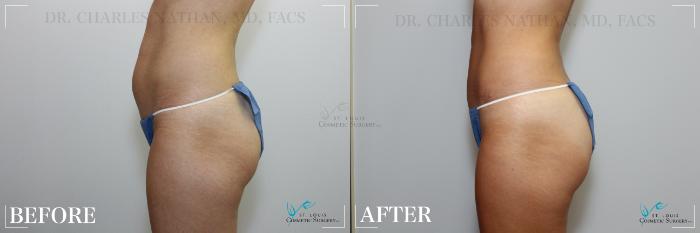Before & After Tummy Tuck Case 218 Left Side View in St. Louis, MO