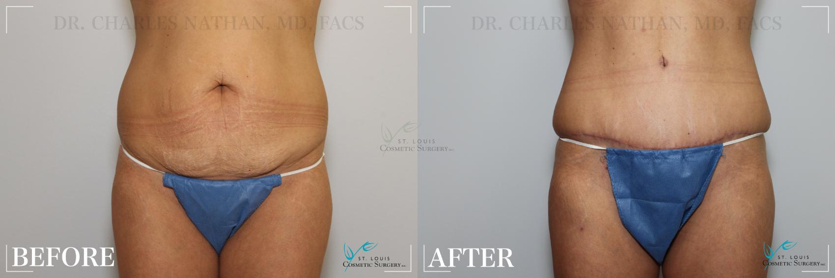 Before & After Tummy Tuck Case 219 Front View in St. Louis, MO