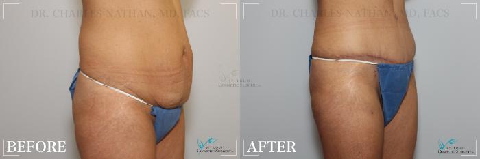 Before & After Tummy Tuck Case 219 Right Oblique View in St. Louis, MO