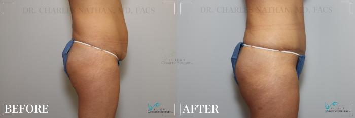 Before & After Tummy Tuck Case 219 Right Side View in St. Louis, MO