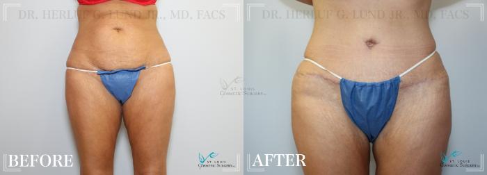 Before & After Tummy Tuck Case 221 Front View in St. Louis, MO