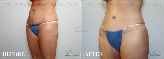 Before & After Tummy Tuck Case 221 Left Oblique View in St. Louis, MO