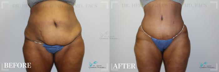 Before & After Tummy Tuck Case 223 Front View in St. Louis, MO