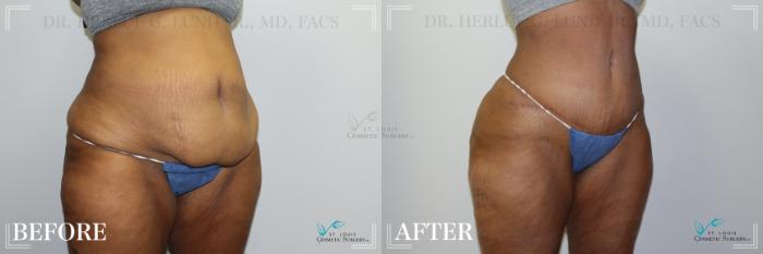 Before & After Tummy Tuck Case 223 Right Oblique View in St. Louis, MO